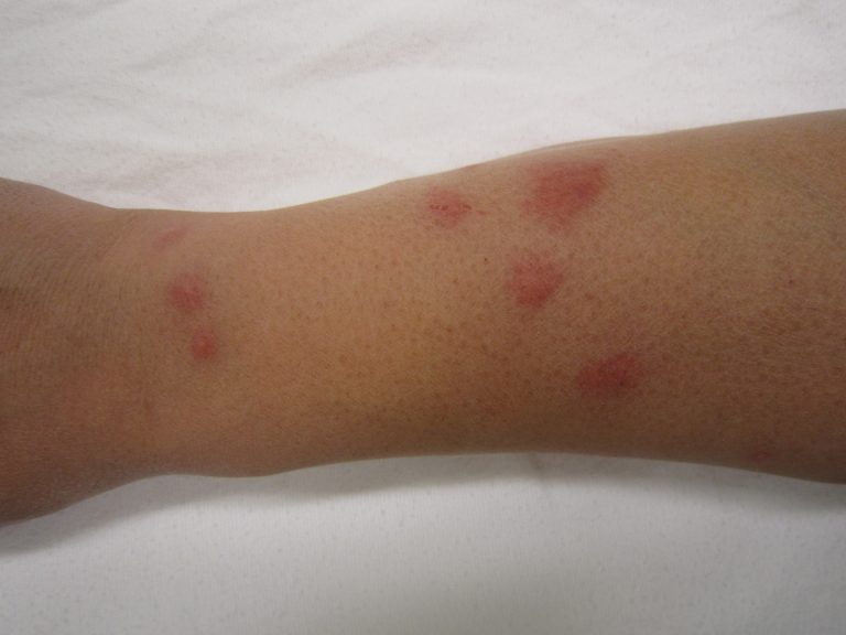 bed bug bites