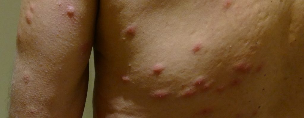 bed bug bites on back - close view