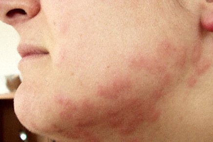 bed bug bites on face