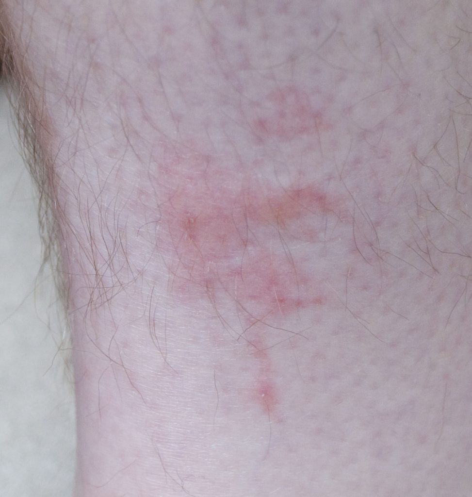 bedbug bites on leg