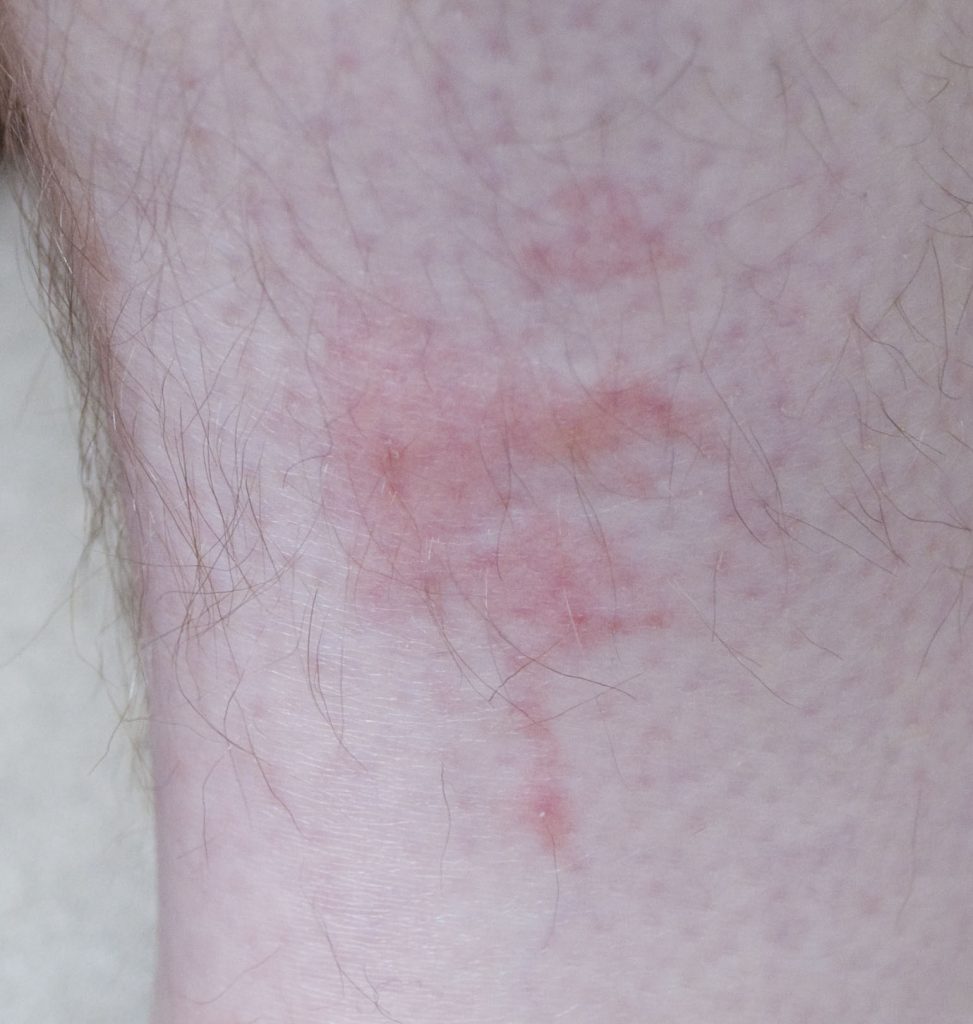 bedbug bites on leg