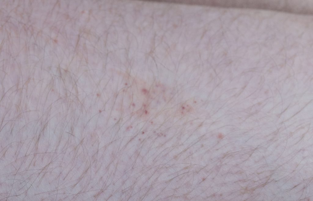 beg bug bites on skin - close view
